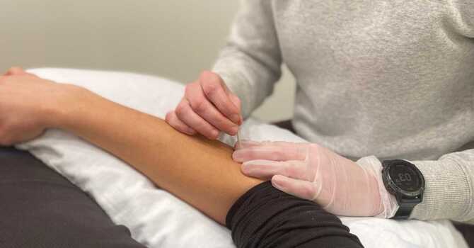 What is Dry Needling? image