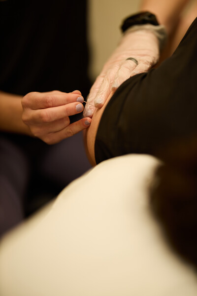 Dry needling treatment provided by physiotherapist while holding dry needle and other hand gloved